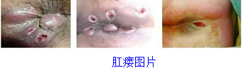 肛瘘