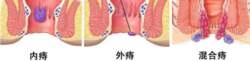 内痔、外痔、混合痔图片