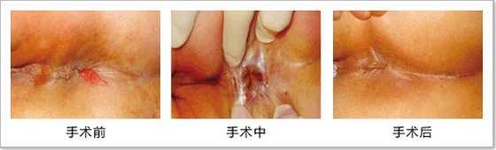 手术前后对比