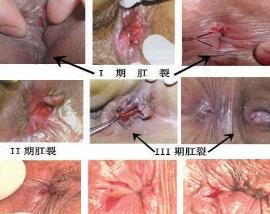 肛裂